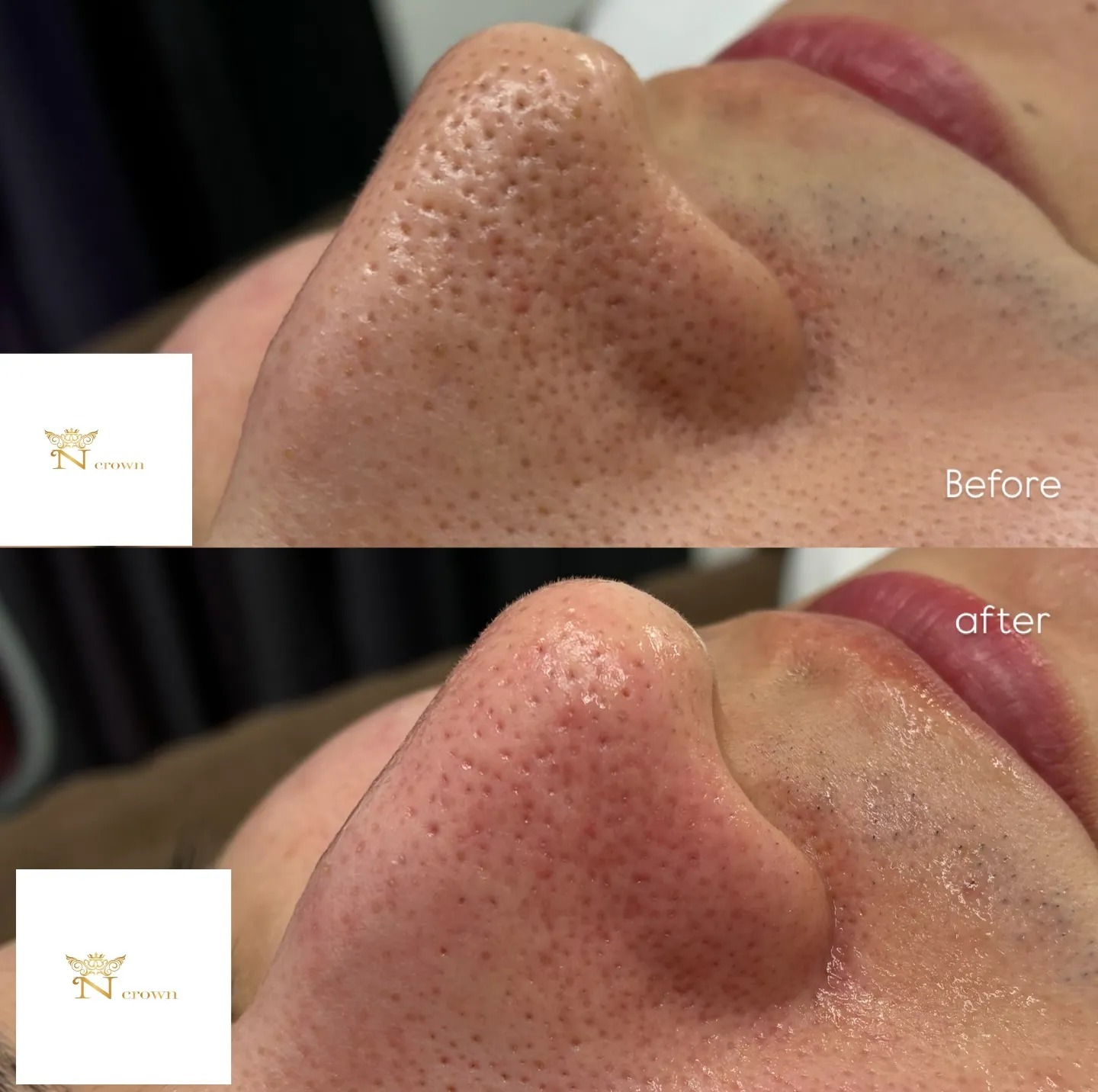 【神戸市垂水区/脱毛/毛穴ケア】ご新規様承り中✨