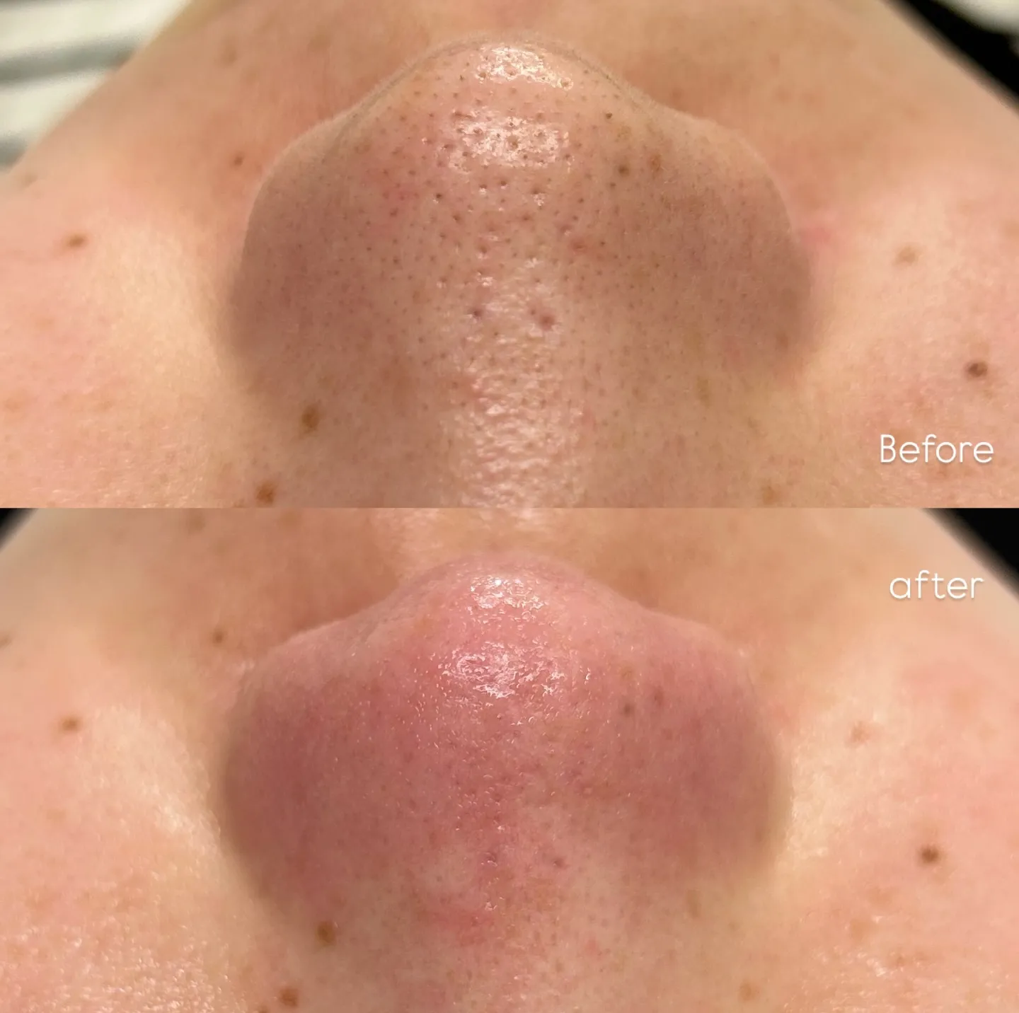 【神戸市垂水区/脱毛/毛穴ケア】ご新規様承り中✨