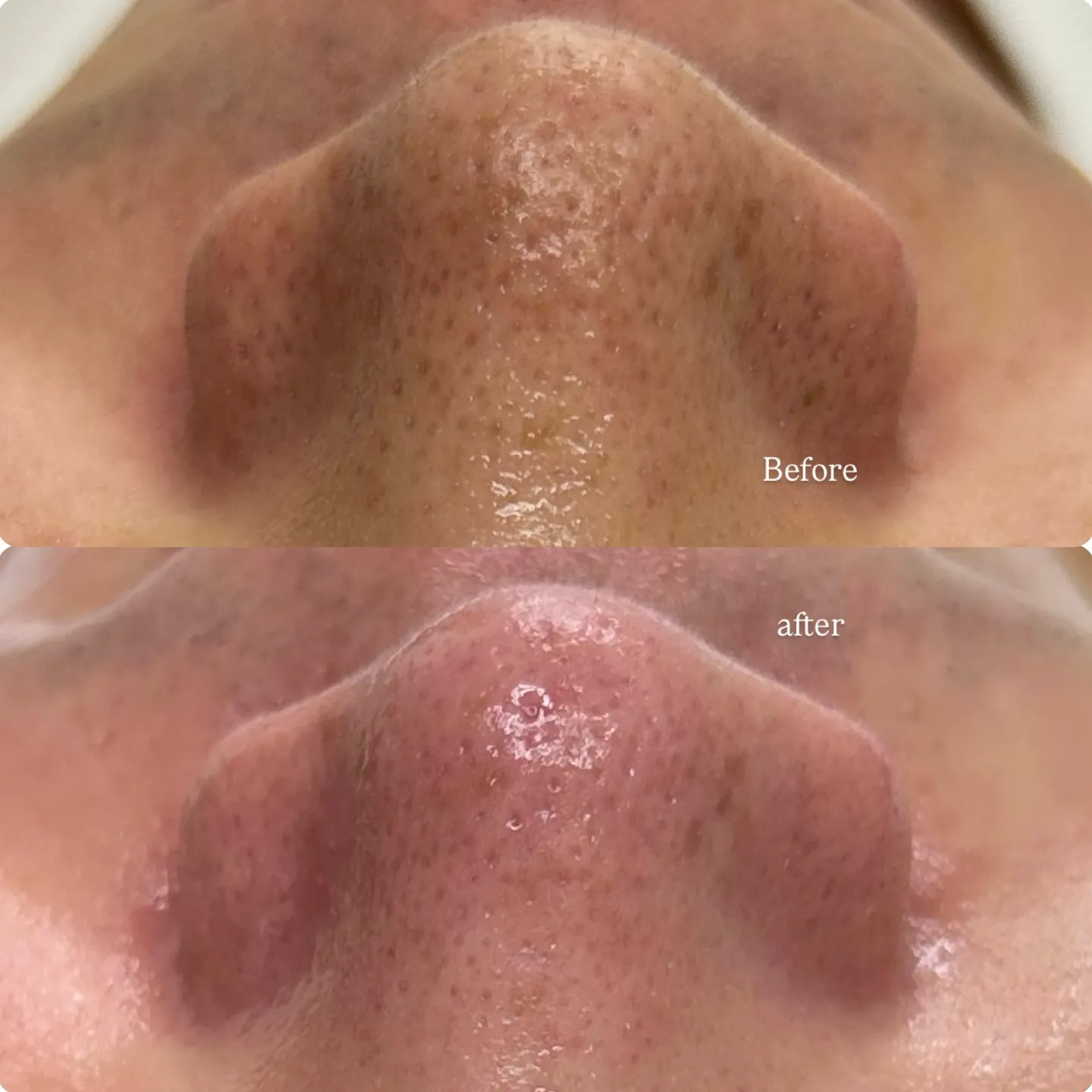 【毛穴エクストラクション施術📷 Before/after 】