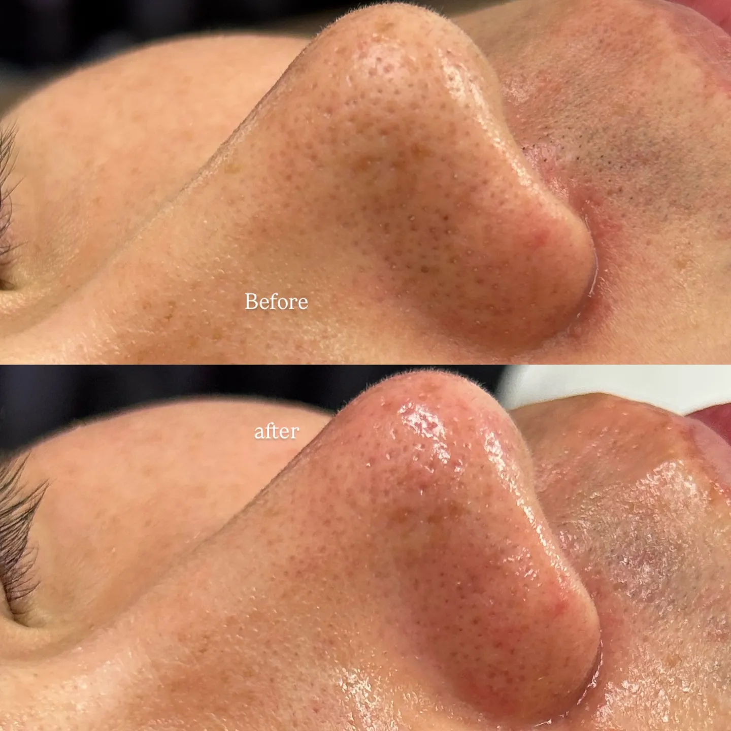 【毛穴エクストラクション施術📷 Before/after 】