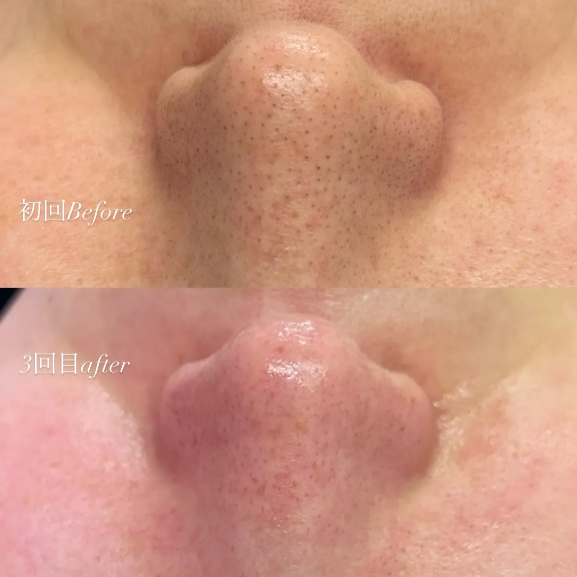 【垂水区／毛穴エクストラクションBefore  after】