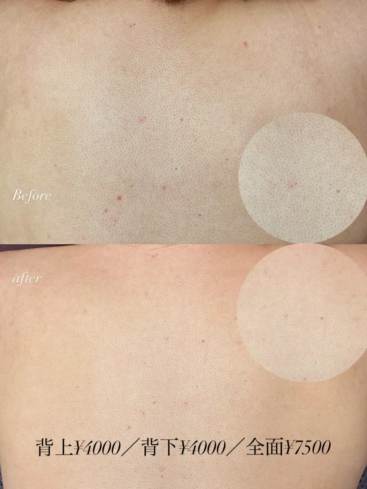 【明石・舞子からのアクセス◎都度払い脱毛★】